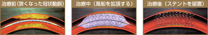 血管内の状態
